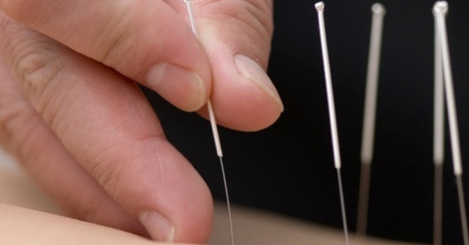 Acupuncture